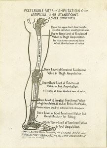 Amputation chart