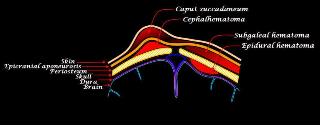 Cephalohematoma Symptoms